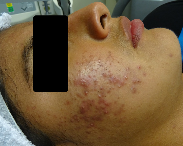 Hidratación con Hialurónico — antes