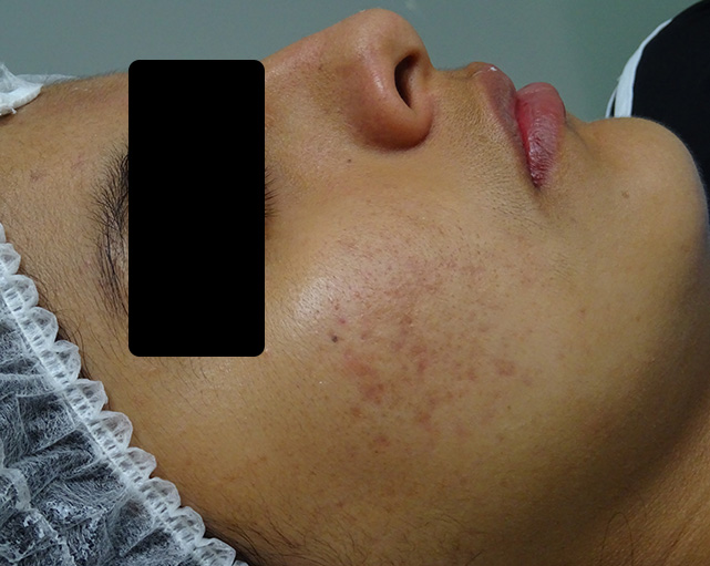 Hidratación con Hialurónico — después